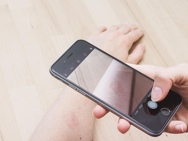 Mithilfe eines Handys und der Kamerafunktion wird ein Foto einer geröteten Hautstelle am Arm abfotografiert..