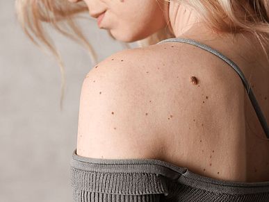 Muttermahl auf der Schulter einer Frau