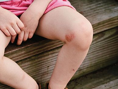 Beine eines Kindes in Sommerbekleidung mit Neurodermitis am Knie auf einer Holztreppe.
